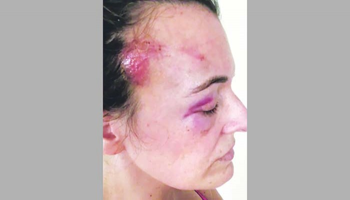 বিক্ষোভে পুলিশের বল প্রয়োগে আহত পিয়ার্সকে ২৫.৬ মিলিয়ন ডলার ক্ষতিপূরণের নির্দেশ